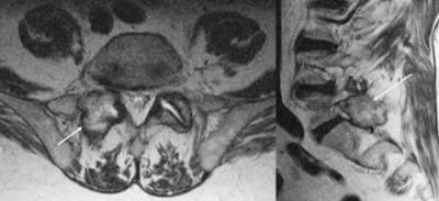 Gout In Back Image