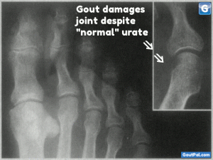 Normal Urate Levels Destroy Bone X-ray Image